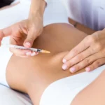 Mesoterapia virtual en Málaga