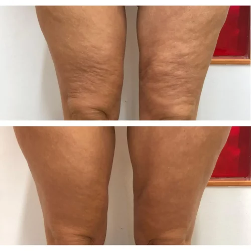 piernas Piernas